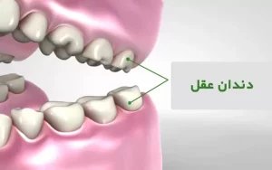 جراحی دندان عقل 