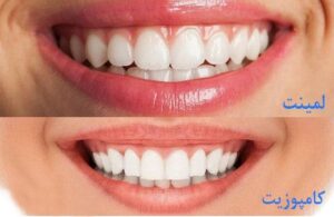 تفاوت لمینت و کامپوزیت دندان