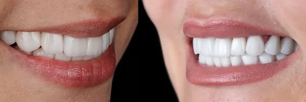 تفاوت لمینت و کامپوزیت دندان