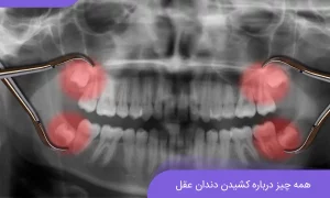 جراحی دندان عقل 